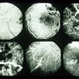 Eales Disease Eales Disease